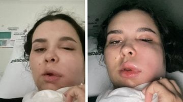 A retirada dos dentes do siso de Ana Luiza evoluíram para um quadro de infecção. - Imagem: reprodução/TikTok @anarenosto.1