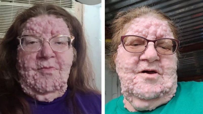 A neurofibromatose tipo 1 atinge um a cada 5 mil brasileiros - Imagem: reprodução/TikTok @hurricanemercedes1