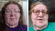 A neurofibromatose tipo 1 atinge um a cada 5 mil brasileiros - Imagem: reprodução/TikTok @hurricanemercedes1