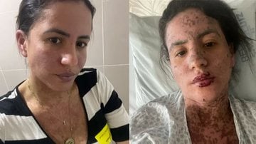 Carol Santos ficou internada por 10 dias na UTI com Síndrome de Stevens-Johnson - Imagem: Reprodução  / Instagram