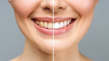 Veja se é seguro usar cúrcuma como clareador de dentes. - Aleksandr Rybalko/ iStock