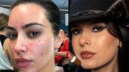 Confira as famosas que já falaram sobre acne. - Reprodução/Kim Kardahian/Ana Castela