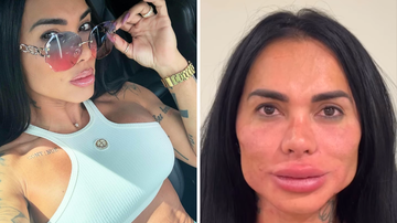 Kamila chocou os internautas ao divulgar o seu rosto inchado e deformado após desarmonização facial. - Reprodução / Instagram