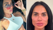 Kamila chocou os internautas ao divulgar o seu rosto inchado e deformado após desarmonização facial. - Reprodução / Instagram