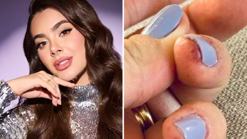 Juliana Leme utilizava unhas de gel desde os 15 anos e descobriu que sofre com alergia ao ativo metil metacrilato. - Reprodução / Redes Sociais