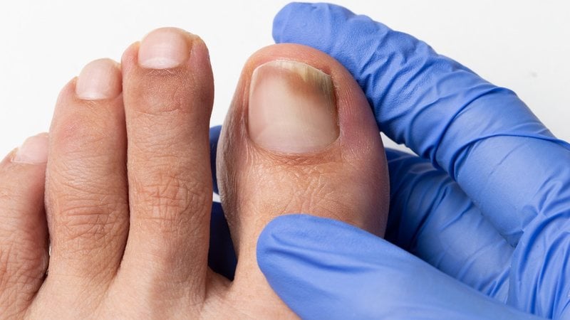 As unhas também estão suscetíveis ao câncer. - Cunaplus_M.Faba / iStock