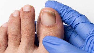 As unhas também estão suscetíveis ao câncer. - Cunaplus_M.Faba / iStock