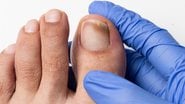 As unhas também estão suscetíveis ao câncer. - Cunaplus_M.Faba / iStock