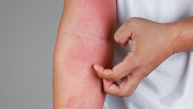 A dermatite de contato está entre as condições mais comuns durante o calor. - tylim / iStock