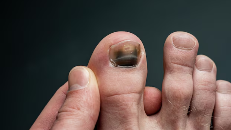 As unhas pretas podem ser motivo de preocupação. - Reprodução / Freepik