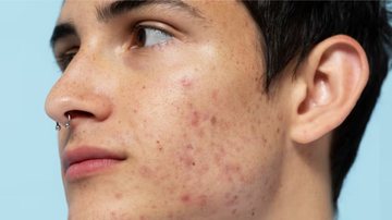 A acne pode ser uma grande inimiga, porém, pode ser resolvida facilmente. - Reprodução / Freepik