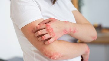 Pessoa com lesões causadas pela psoríase