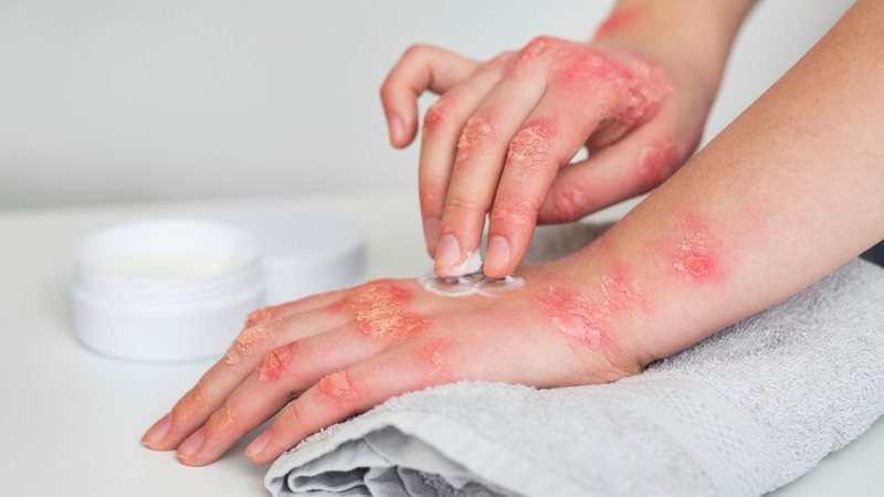 Pessoa com lesões de psoríase nas mãos