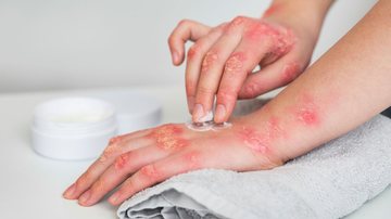 Pessoa com lesões de psoríase nas mãos