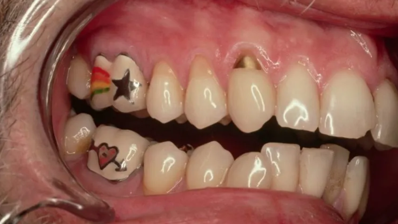 foto de boca aberta mostrando dentes tatuados