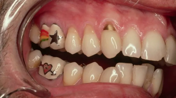 foto de boca aberta mostrando dentes tatuados