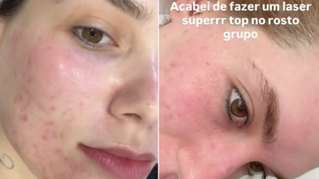 Virginia Fonseca mostra rosto vermelho após procedimentos.