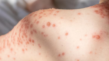 Criança com erupções cutâneas causadas pela catapora.