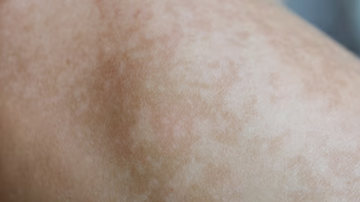 Imagem aproximada de pele lesionada com melasmas.