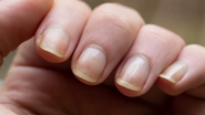 unhas amareladas