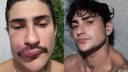 influenciador com o rosto inchado devido a infecção na espinha