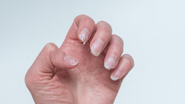 Unhas quebradiças, descamando.