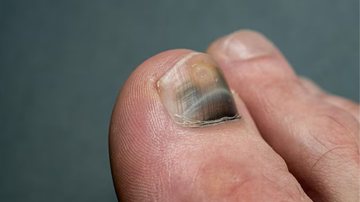 unhas com hematoma roxo escuro.