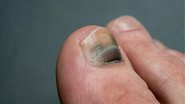 unhas com hematoma roxo escuro.