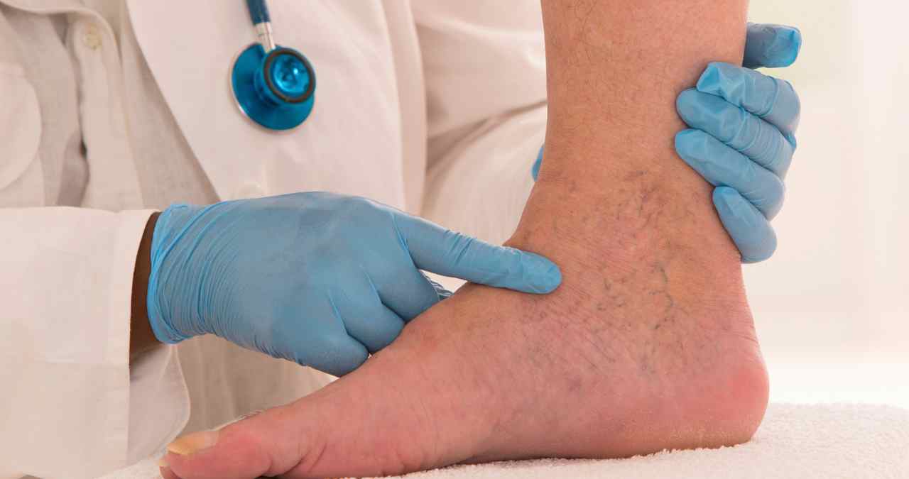 análise clínica sendo realizada em um possível caso de edema nos pés