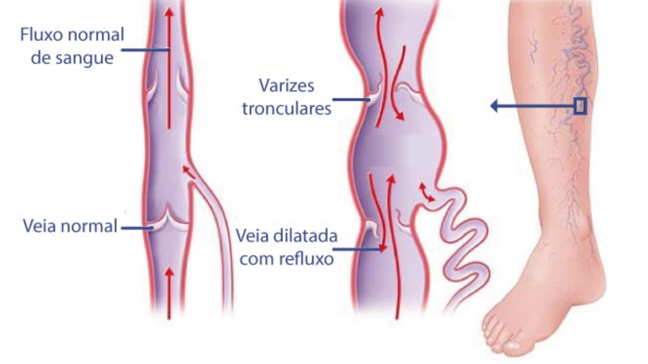 Reprodução/saudebemestar.pt