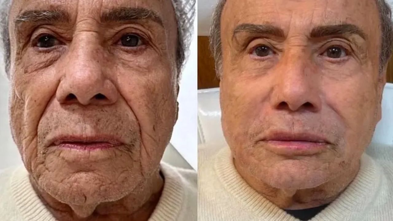 Em alta entre os famosos, a harmonização facial é um procedimento criado para deixar o rosto humano mais proporcional 