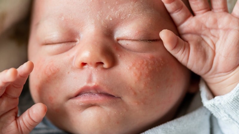 acne neonatal