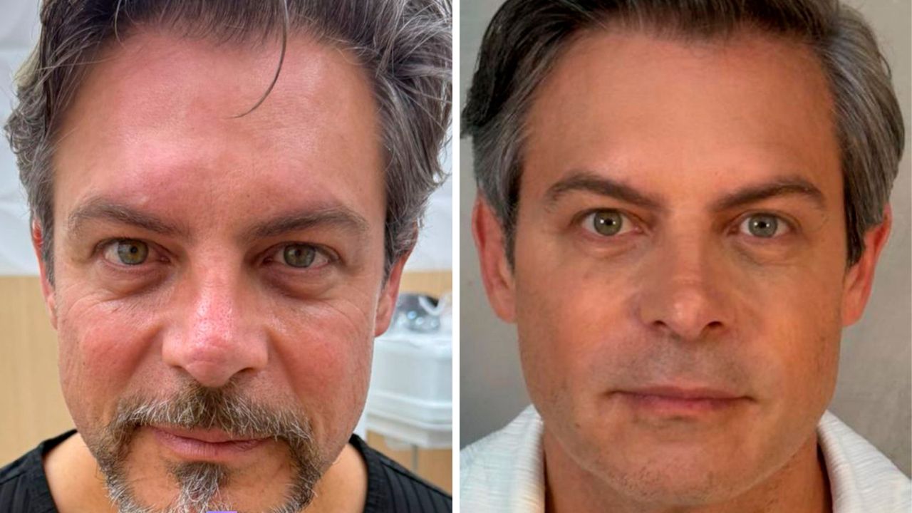 Antes e depois de Luigi Baricelli