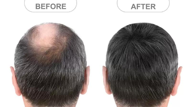 minoxidil antes e depois homem calvo