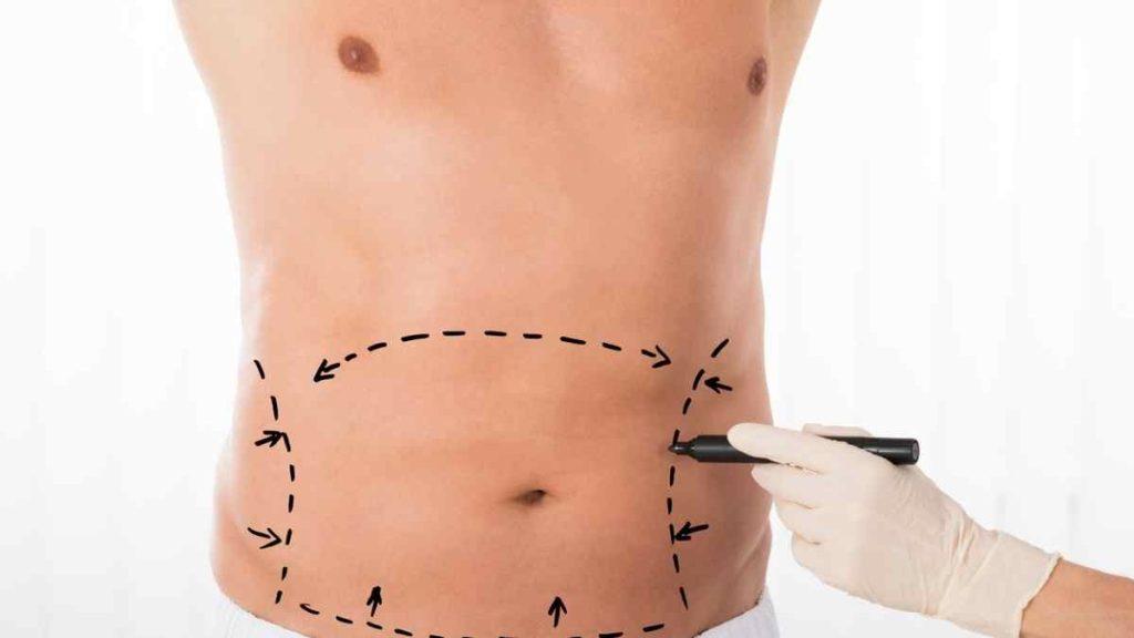 abdominoplastia 