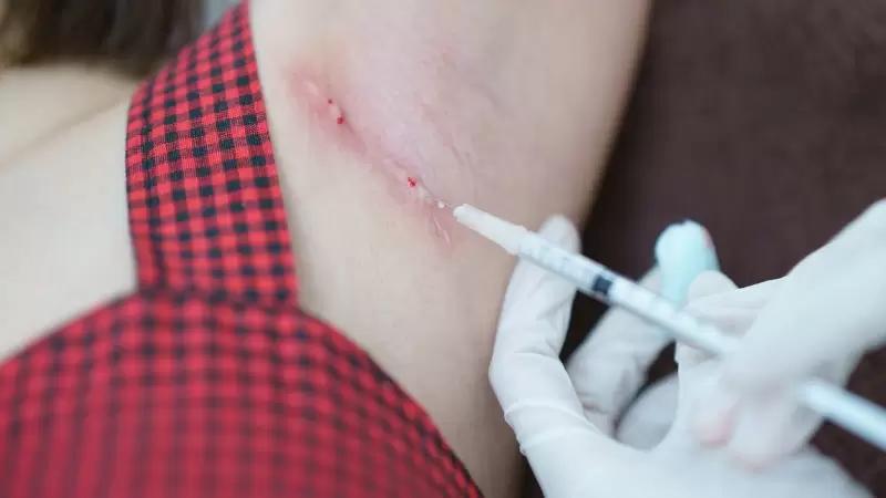 injecao contra queloide aplicada por medico