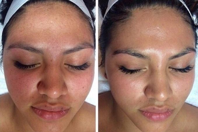 peeling de diamante antes e depois