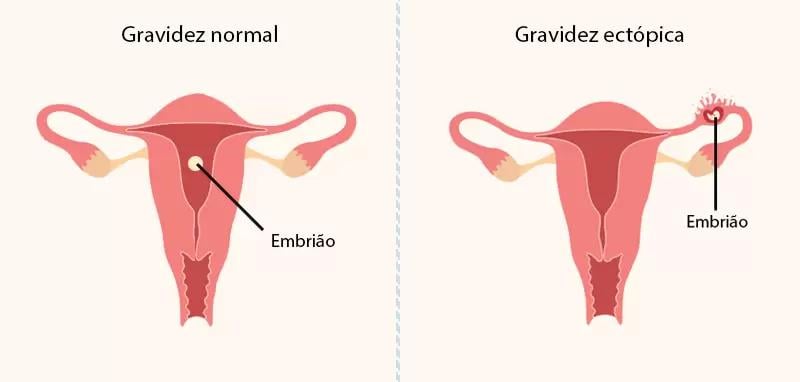 gravidez ectopica