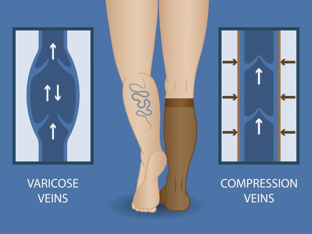 Meia de Compressão