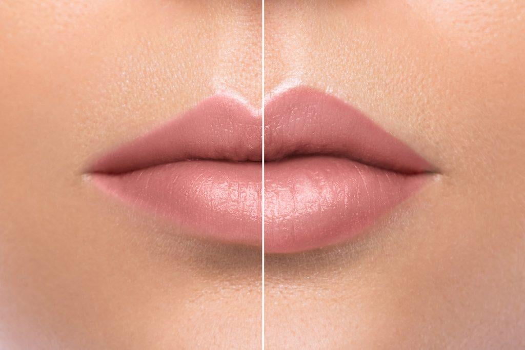 antes e depois preenchimento labial