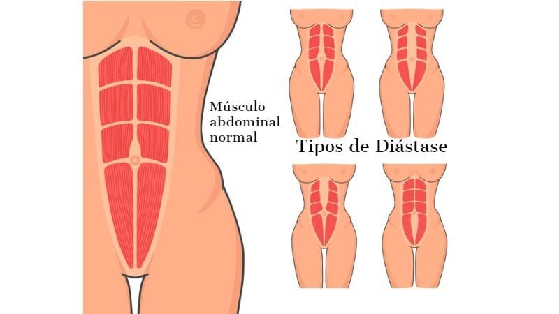 tipos de diástase