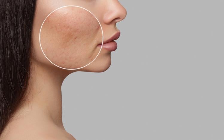 acne afeta adultos também