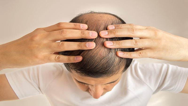 alopecia queda de cabelo 